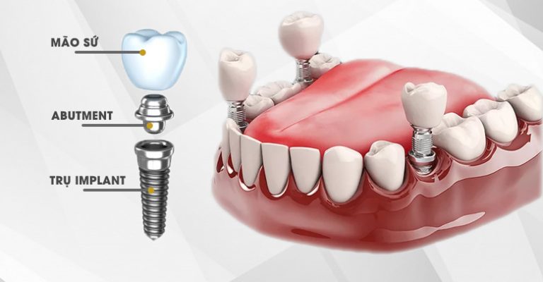 CẤY GHÉP IMPLANT NHA KHOA TOÀN HÀM VÀ NHỮNG ĐIỀU CẦN BIẾT